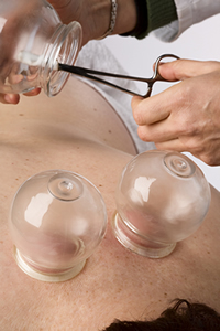 cupping